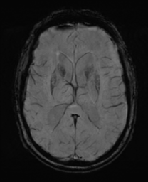 File:Alzheimer's disease- with Gerstmann syndrome and dressing apraxia (Radiopaedia 54882-61150 Axial SWI 19).png