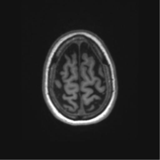 Alzheimer's disease (Radiopaedia 42658-45802 Axial T1 27).png