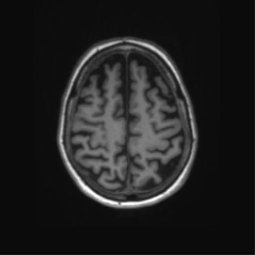 File:Alzheimer's disease (Radiopaedia 42658-45802 Axial T1 40).png