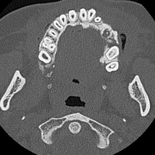 Ameloblastic fibro-odontoma (Radiopaedia 18843-18780 C 47).jpg