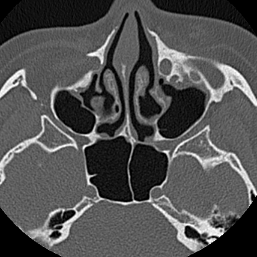 Ameloblastic fibro-odontoma (Radiopaedia 18843-18780 C 5).jpg