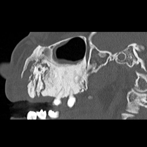 File:Ameloblastic fibro-odontoma (Radiopaedia 18843-18780 bone window 8).jpg