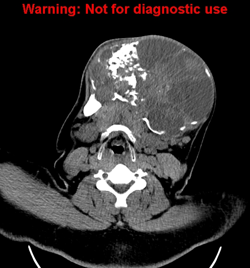 File:Ameloblastoma (Radiopaedia 33126-34164 A 18).jpg