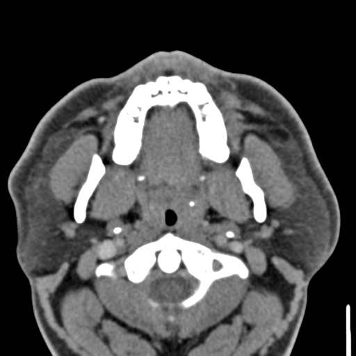 File:Ameloblastoma (Radiopaedia 33677-34806 Axial non-contrast 14).png