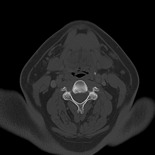 Ameloblastoma (Radiopaedia 38520-40623 Axial bone window 40).png