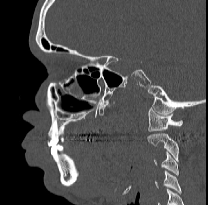 Ameloblastoma (Radiopaedia 77750-89997 Sagittal bone window 13).jpg
