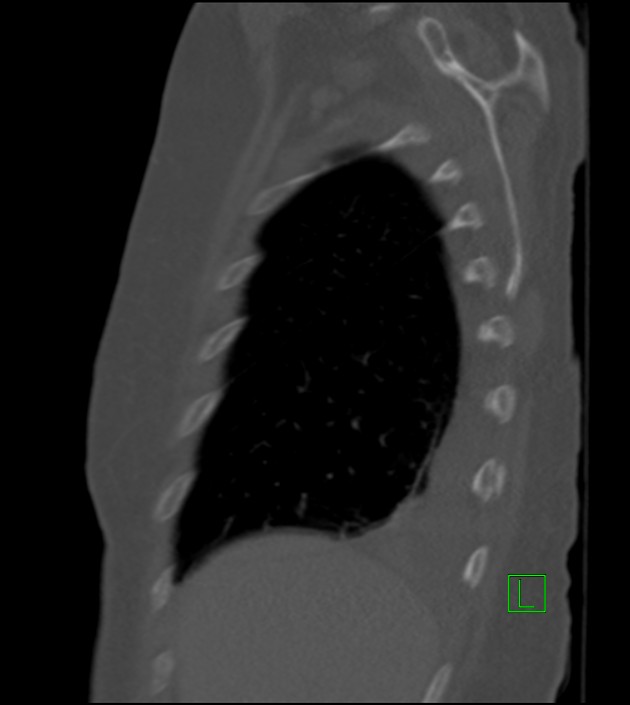 Amiodarone deposition in the liver (Radiopaedia 77587-89780 Sagittal bone window 81).jpg
