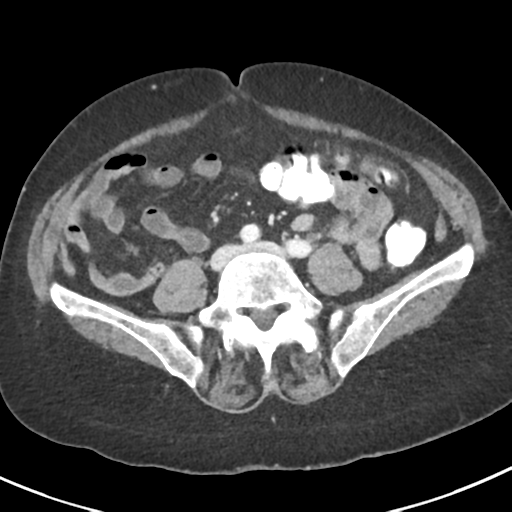 Ampullary adenocarcinoma (Radiopaedia 34013-35237 C 34).png