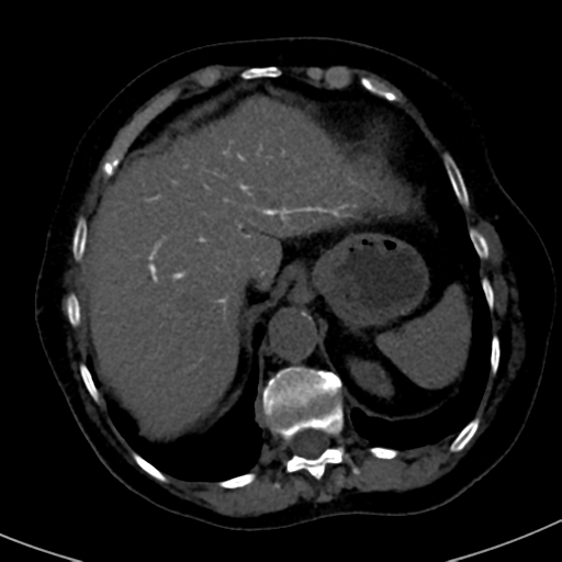File:Ampullary adenocarcinoma (Radiopaedia 34013-35241 AXIAL THICK 14).png