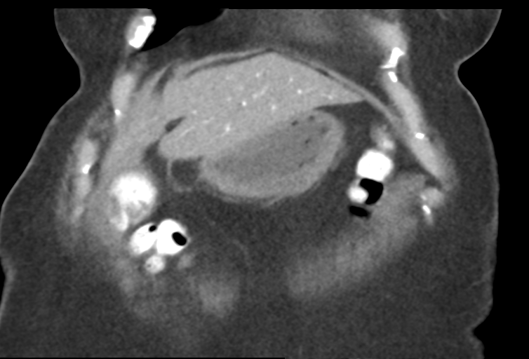 Ampullary adenocarcinoma (Radiopaedia 34013-35241 Coronal 9).png