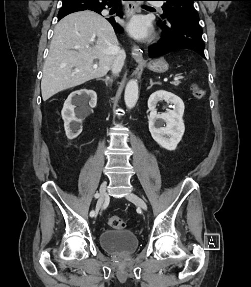 Ampullary adenocarcinoma (Radiopaedia 59373-66734 D 65).jpg