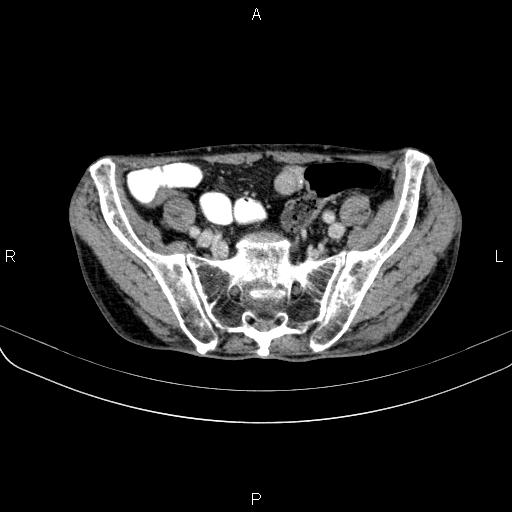 File:Ampullary adenocarcinoma (Radiopaedia 86093-102033 B 94).jpg
