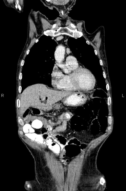 Ampullary adenocarcinoma (Radiopaedia 86093-102033 D 15).jpg