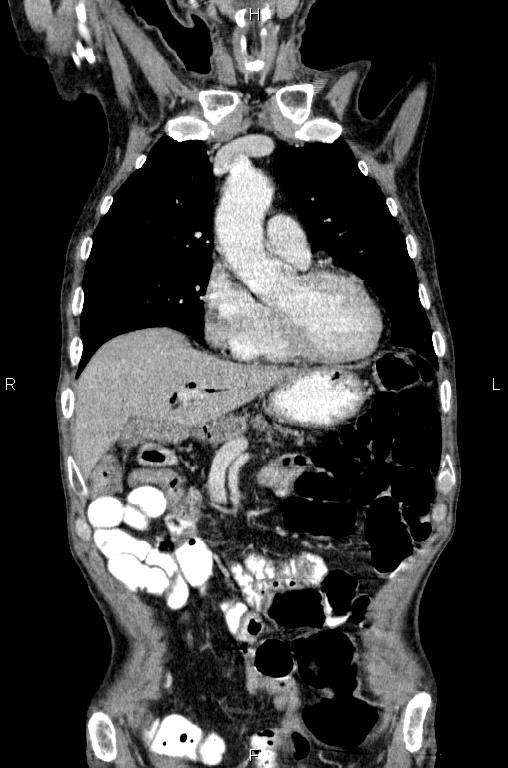 Ampullary adenocarcinoma (Radiopaedia 86093-102033 D 18).jpg