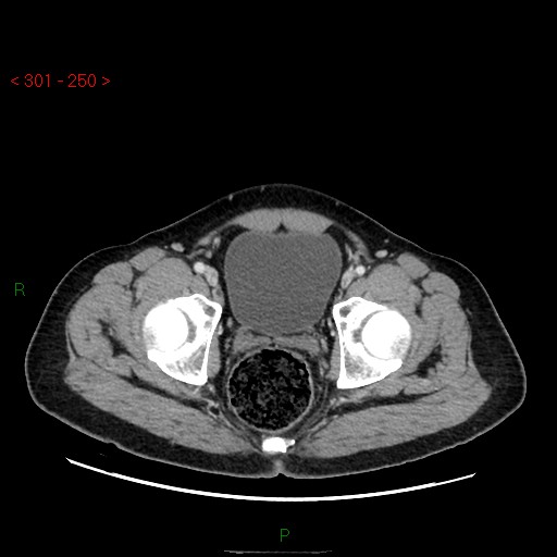 Ampullary carcinoma (Radiopaedia 56396-63056 C 94).jpg