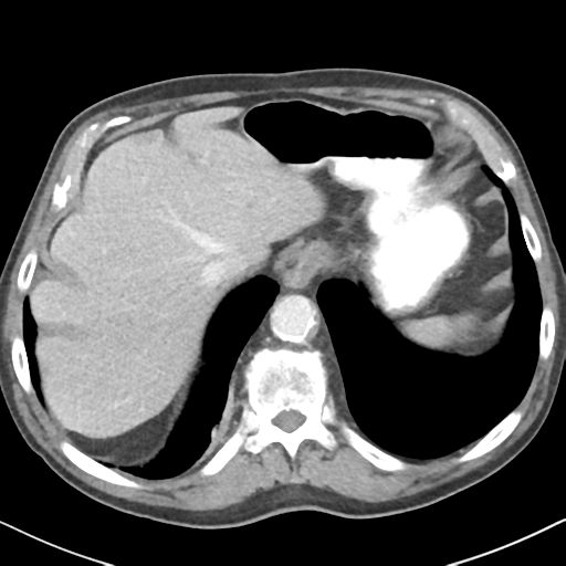 File:Amyand hernia (Radiopaedia 39300-41547 A 9).png