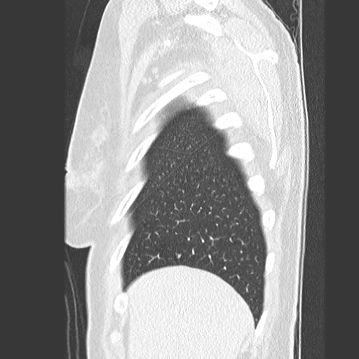File:Amyloidosis - bronchial and diffuse nodular pulmonary involvement (Radiopaedia 60156-67745 Sagittal lung window 10).jpg