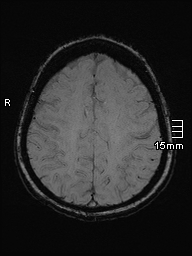 File:Amyotrophic lateral sclerosis (Radiopaedia 70821-81017 Axial SWI 41).jpg