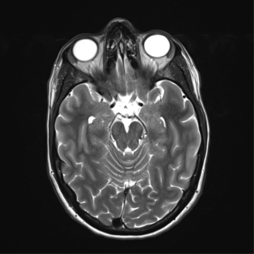 File:Anaplastic astrocytoma IDH mutant (Radiopaedia 50046-55341 Axial T2 15).png