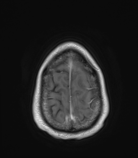 Anaplastic astrocytoma IDH wild-type (Radiopaedia 49984-55273 Axial T1 C+ 51).png