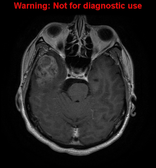 File:Anaplastic ganglioglioma (Radiopaedia 44921-48831 Axial T1 C+ 10).jpg
