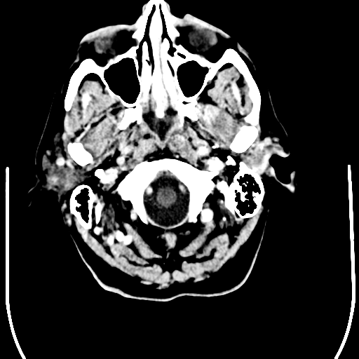 File:Anaplastic meningioma with recurrence (Radiopaedia 34452-35781 Axial Contrast 2).png