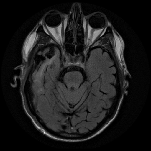 File:Anaplastic meningioma with recurrence (Radiopaedia 34452-35791 Axial FLAIR 7).png