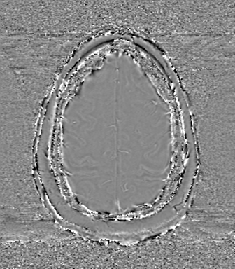 File:Anaplastic oligodendroglioma (Radiopaedia 83500-98599 Axial SWI - phase 71).png