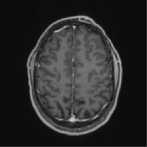 Anaplastic oligodendroglioma with skull fracture (Radiopaedia 74831-85845 Axial T1 C+ fat sat 50).png