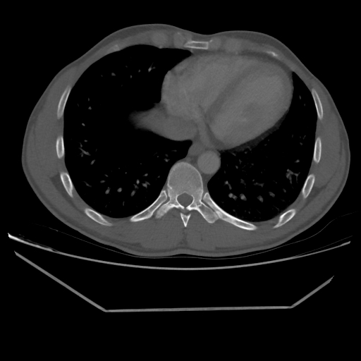 Aneurysmal bone cyst - rib (Radiopaedia 82167-96220 Axial bone window 184).jpg