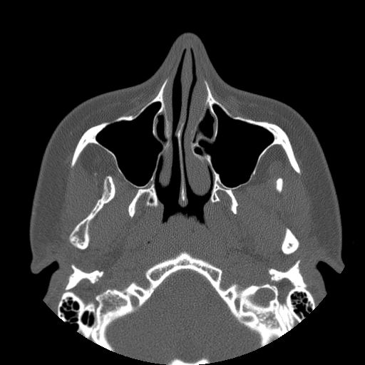 Aneurysmal bone cyst of the mandible (Radiopaedia 43280-46823 Axial bone window 126).jpg