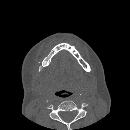 Aneurysmal bone cyst of the mandible (Radiopaedia 43280-46823 Axial bone window 34).jpg