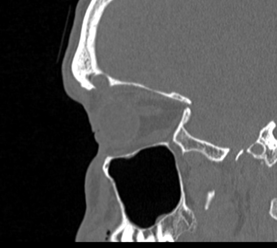 Angular epidermoid cyst (Radiopaedia 46908-51439 Sagittal bone window 68).png