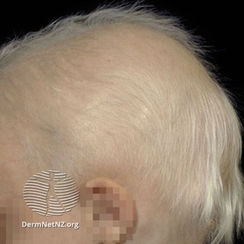 File:Anhidrotic ectodermal dysplasia (DermNet NZ hair-nails-sweat-s-anhidrectdysp).jpg