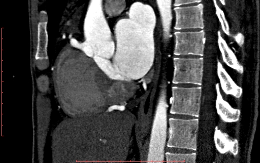 Anomalous left coronary artery from the pulmonary artery (ALCAPA) (Radiopaedia 70148-80181 C 113).jpg