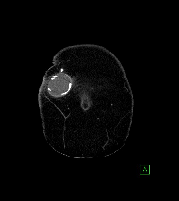 Anterior abdominal wall CSF pseudocyst (CSFoma) (Radiopaedia 79453-92571 B 7).jpg