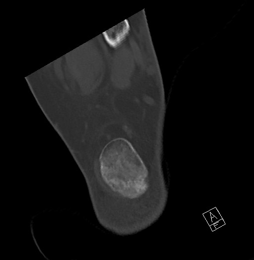 Anterior calcaneal process fracture (Radiopaedia 63353-71943 Axial bone window 120).jpg