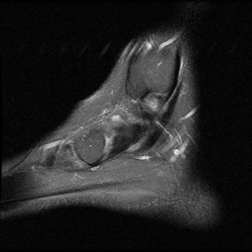 File:Anterior calcaneal process fracture (Radiopaedia 74654-85611 Sagittal PD fat sat 3).jpg