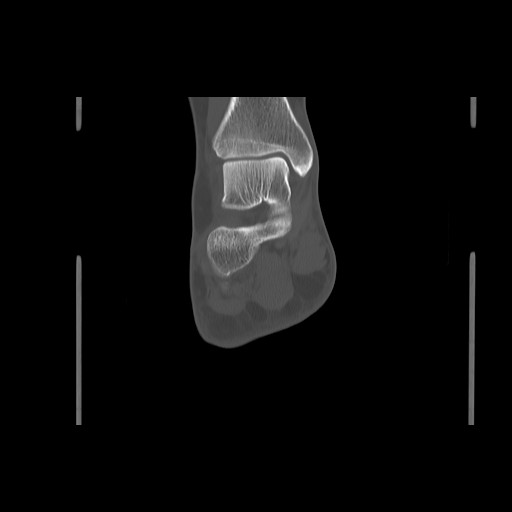 File:Anterior calcaneal process fracture (Radiopaedia 82590-96762 Coronal bone window 54).jpg