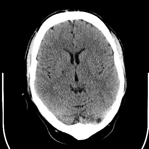 File:Anterior cerebral artery territory infarct (Radiopaedia 39327-41581 Axial non-contrast 13).png