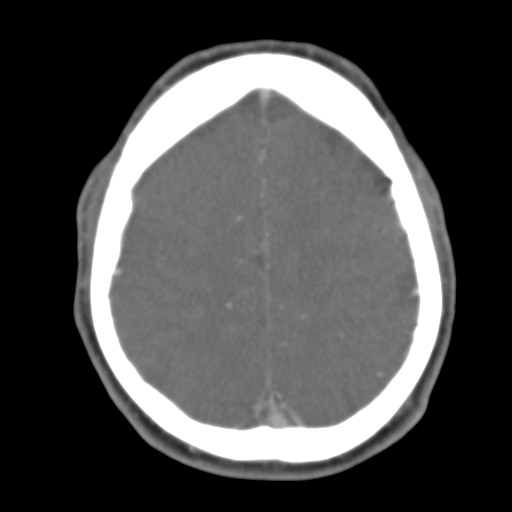 File:Anterior cerebral artery territory infarct (Radiopaedia 39327-41581 B 17).png