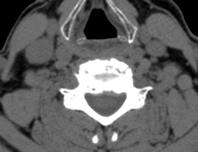 Anterior cervical postdiscectomy arthrodesis (Radiopaedia 32678-33646 Axial non-contrast 48).jpg