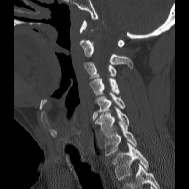 Anterior cervical postdiscectomy arthrodesis (Radiopaedia 32678-33646 Sagittal bone window 28).jpg
