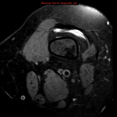 File:Anterior cruciate ligament tear (Radiopaedia 12329-12612 Axial T2 fat sat 24).jpg
