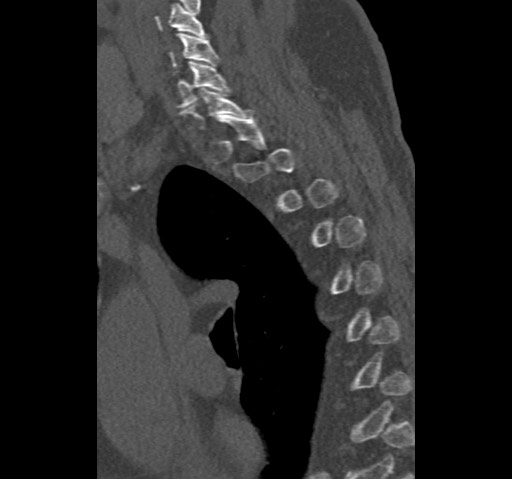 File:Anterior glenohumeral dislocation with Hill-Sachs lesion (Radiopaedia 62877-71249 Sagittal bone window 77).jpg