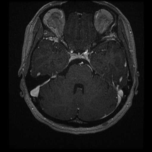 Anterior inferior cerebellar artery vascular loop - type II (Radiopaedia 70991-81209 Axial T1 C+ 21).jpg