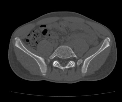 Anterior inferior iliac spine avulsion fracture (Radiopaedia 81312-94999 Axial bone window 21).jpg