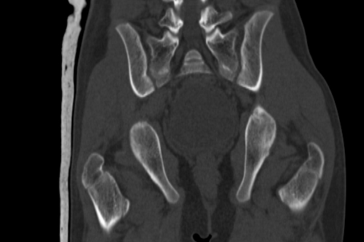 Anterior inferior iliac spine avulsion injury (Radiopaedia 88666-105376 Coronal bone window 47).jpg
