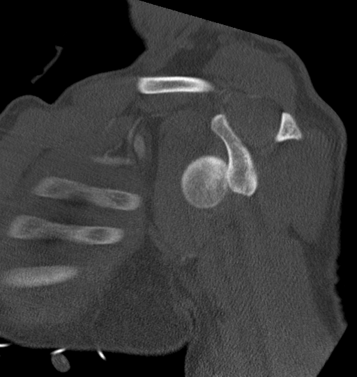 Anterior shoulder dislocation with Hill-Sachs and bony Bankart lesions (Radiopaedia 40424-42974 Sagittal bone window 29).png