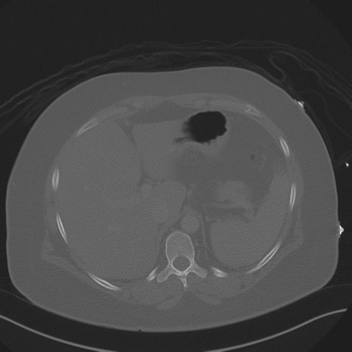 Anterior superior iliac spine avulsion fracture (Radiopaedia 44541-48244 Axial bone window 22).png